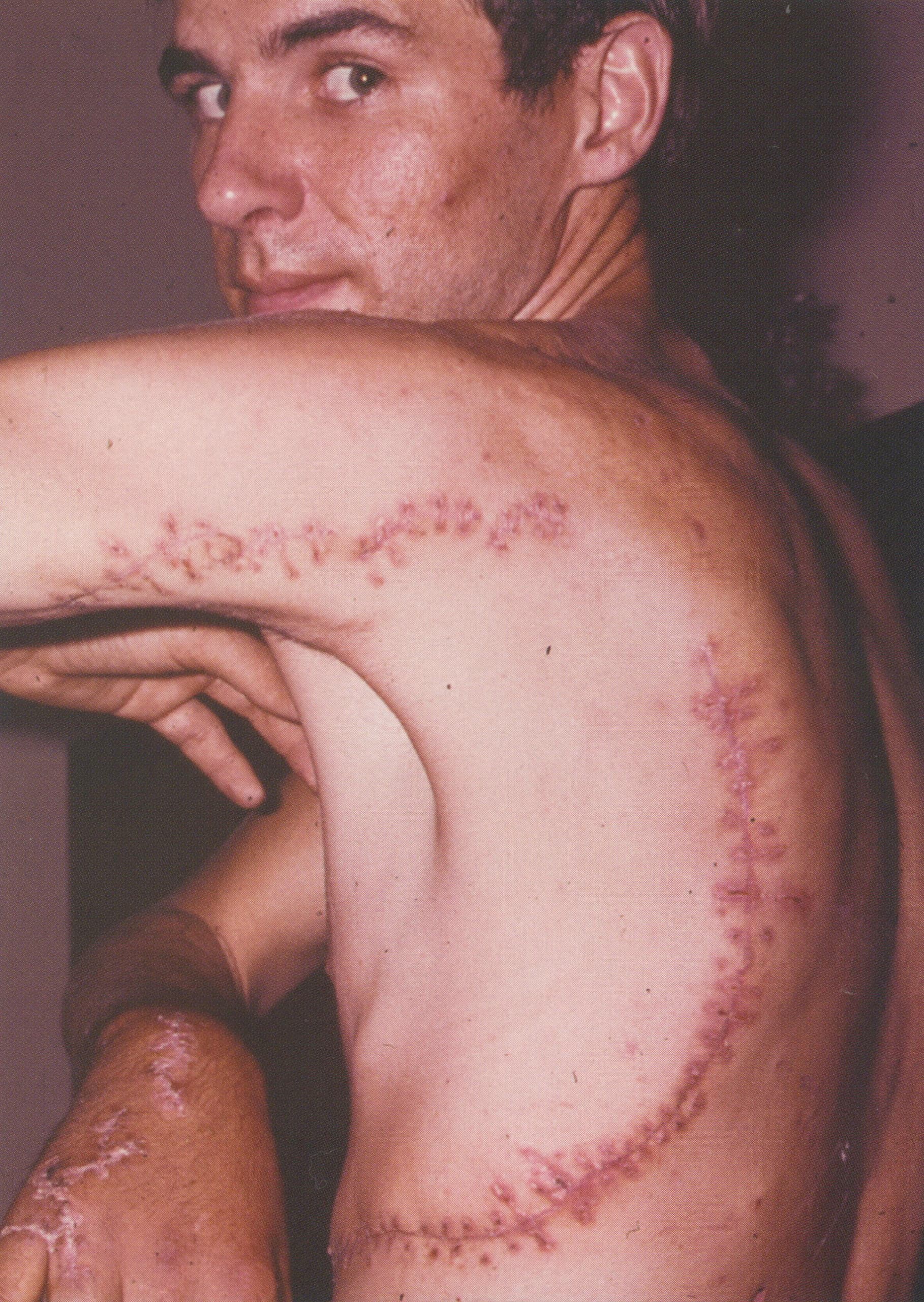 Rodney Fox Scars from Great white shark attack