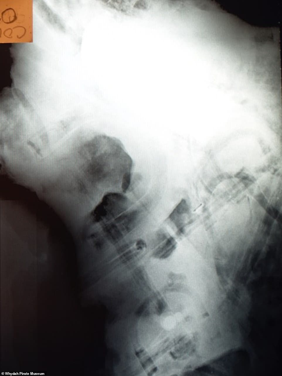 Skeletal remains found on pirate ship off Cape Cod 1 Investigators say the remains were discovered at the wreck site, X-rays showing the skeletal remains
